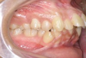 患者様の歯の写真