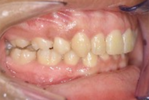 患者様の歯の写真
