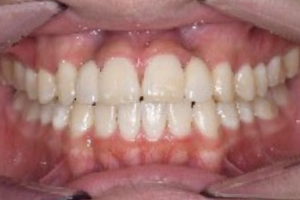 治療後の歯の様子