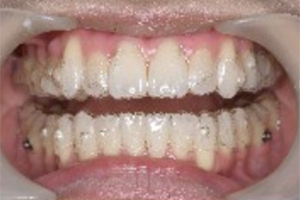 治療中の歯の様子