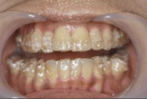 治療中の歯の様子