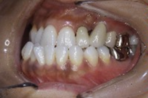 治療前の歯の様子